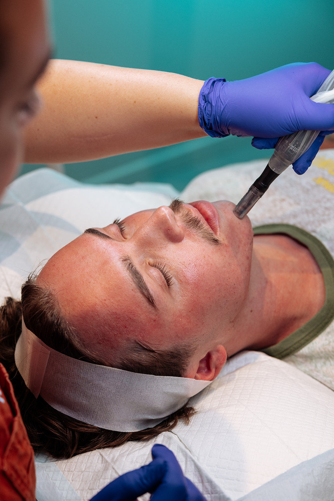 Person receiving a facial treatment with a microneedling device held by a professional wearing gloves.